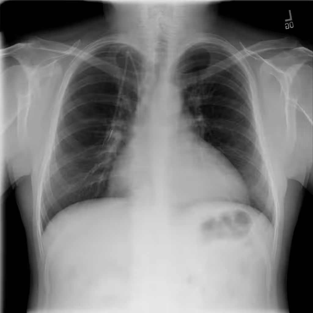 Chest X-Ray